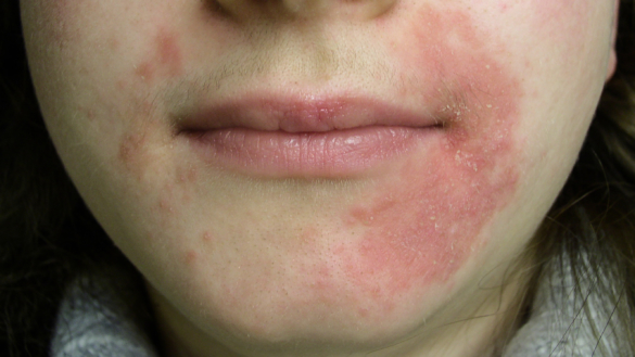 Perioral dermatit (POD) – symtom, orsaker och behandling
